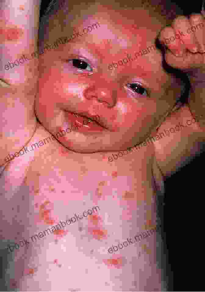 Image Of A Child With Chickenpox Rash A Disease Called Childhood: Why ADHD Became An American Epidemic
