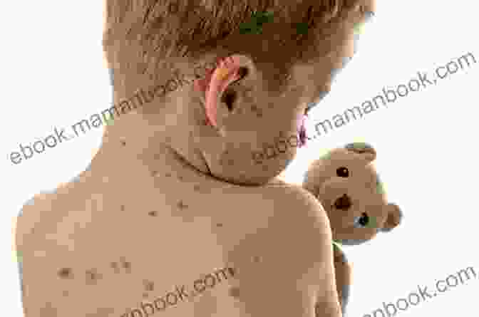 Image Of A Child With Measles Rash A Disease Called Childhood: Why ADHD Became An American Epidemic