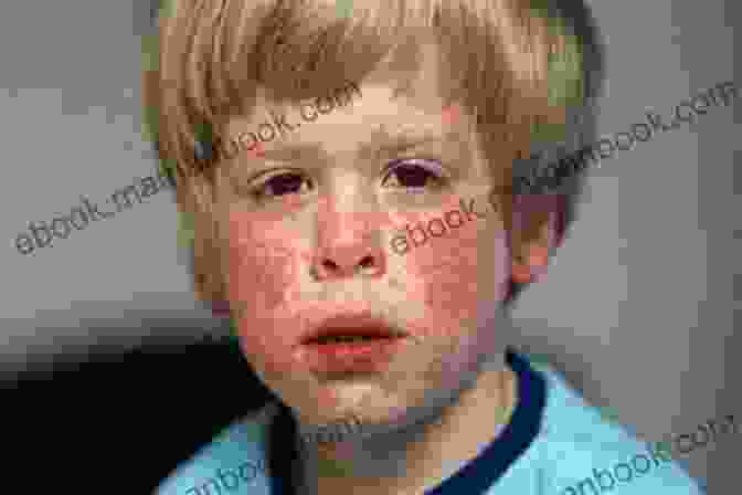 Image Of A Child With Rubella Rash A Disease Called Childhood: Why ADHD Became An American Epidemic